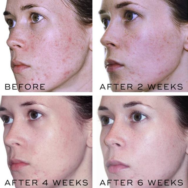 Retinol